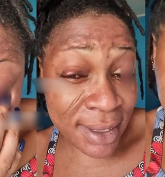 To get belle come dey fear person – Netizens React As Woman Narrates How Pregnancy Affected Her two Eyes (VIDEO)
